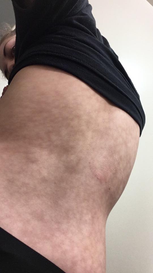 heating pad burns on a woman's skin