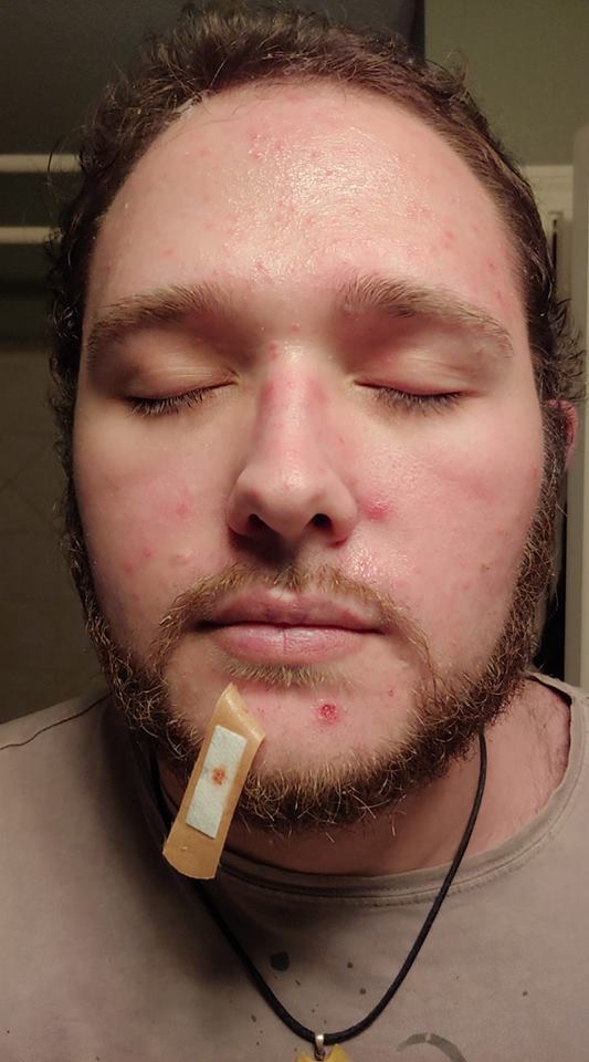 man with hidradenitis suppurativa on his face