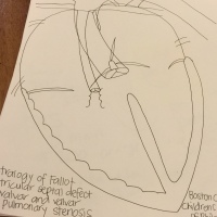 A drawing of a heart with Tetralogy of Fallot.