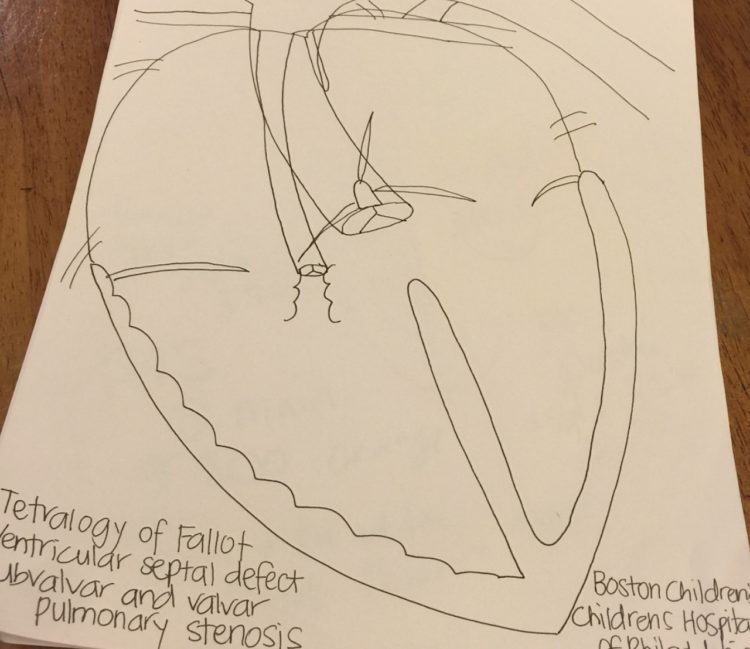 A drawing of a heart with Tetralogy of Fallot.