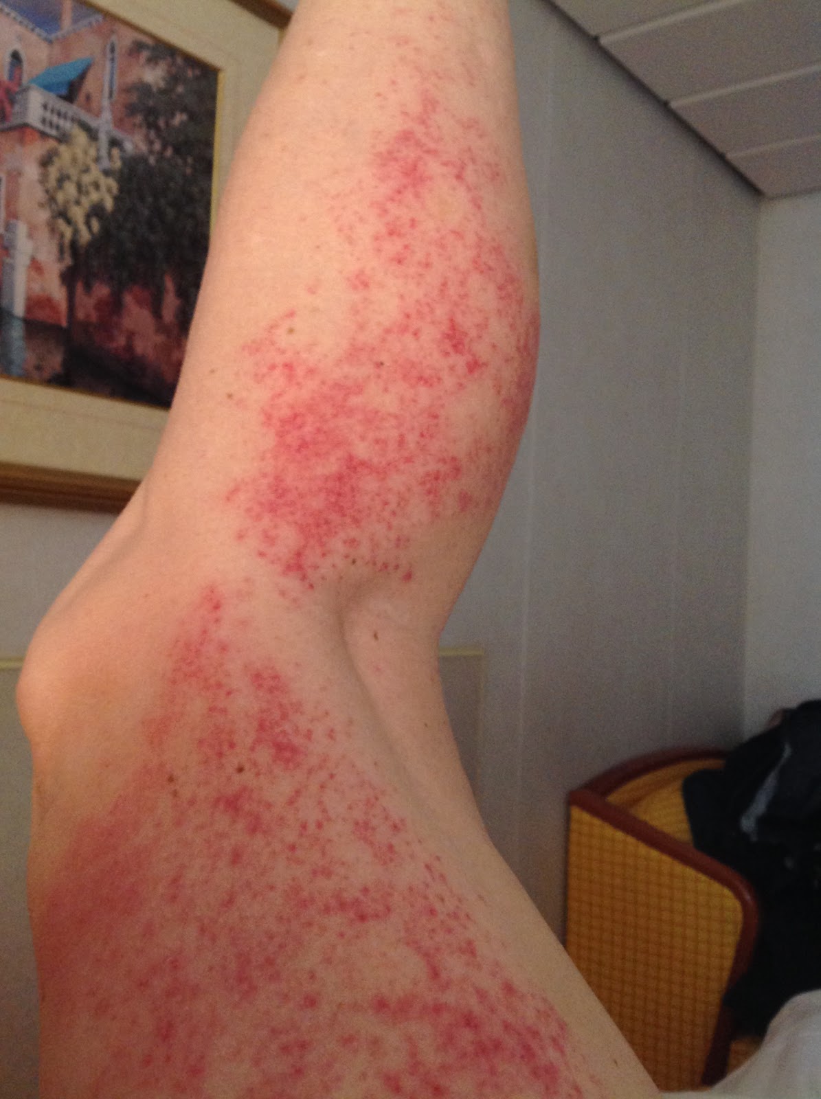 Woman's leg with a bright red rash.