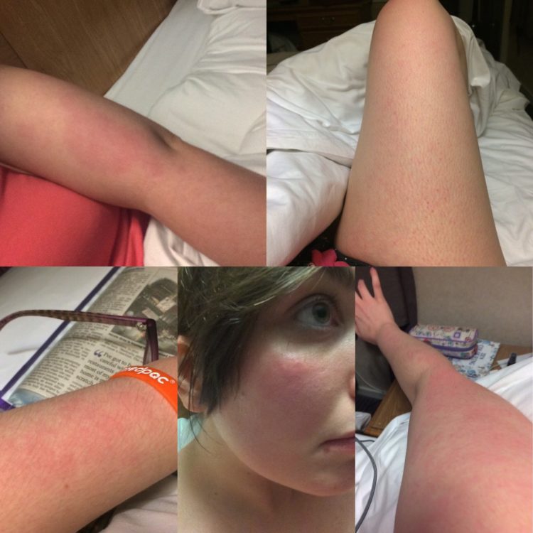 leg and arms with rash 