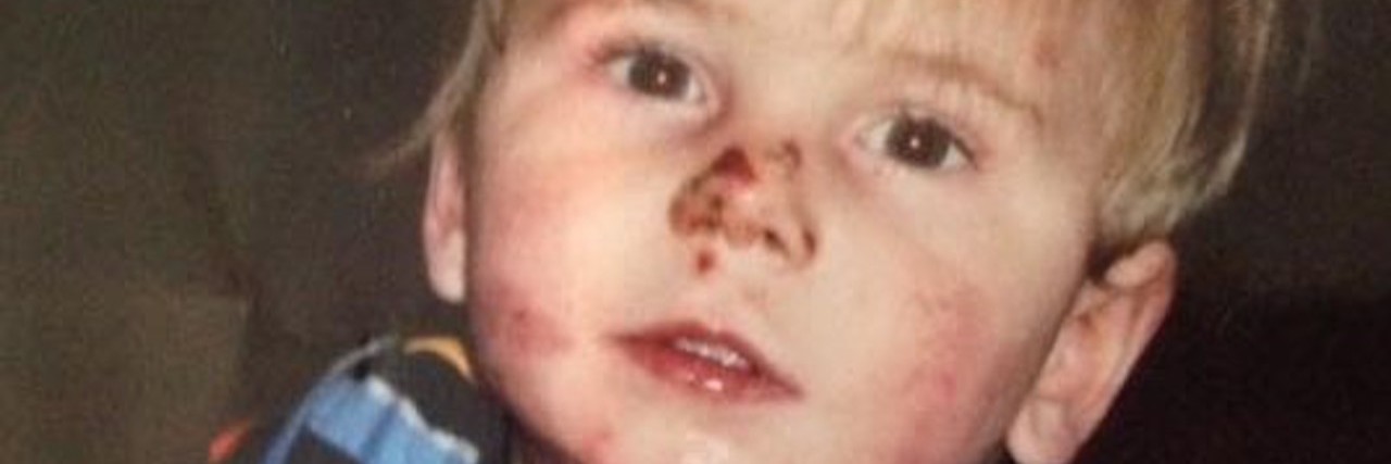 toddler with Epidermolysis Bullosa sitting in a basket