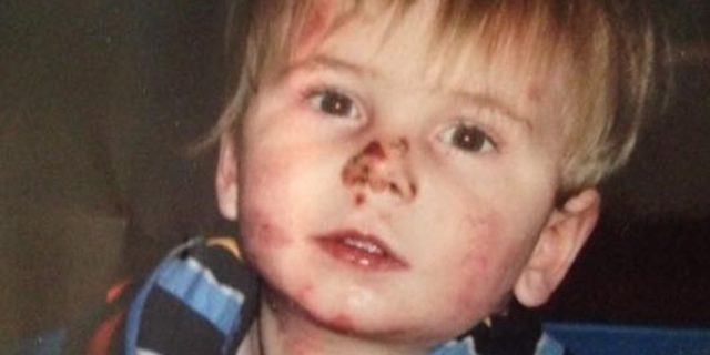 Darwin’s Orphan: A Childhood With Epidermolysis Bullosa toddler with Epidermolysis Bullosa sitting in a basket