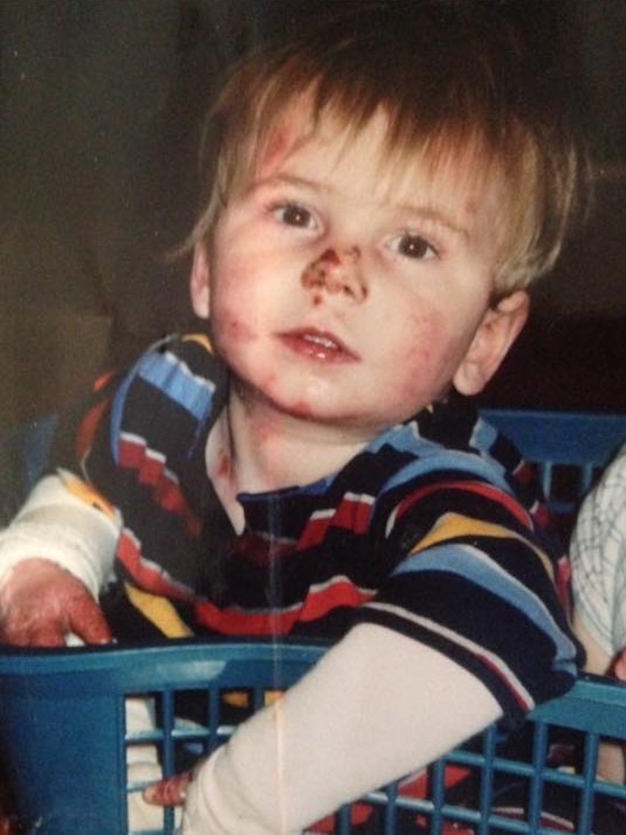 toddler with Epidermolysis Bullosa sitting in a basket