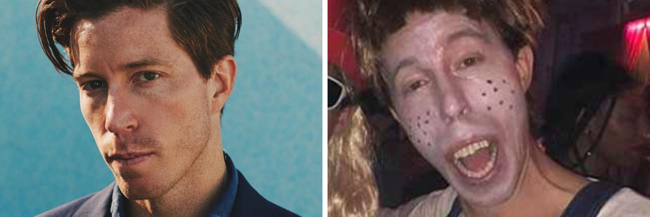 Olympian Shaun White Apologizes for Insensitive Halloween Costume Shaun White dressed normally and Shaun White dressed as Simple Jack