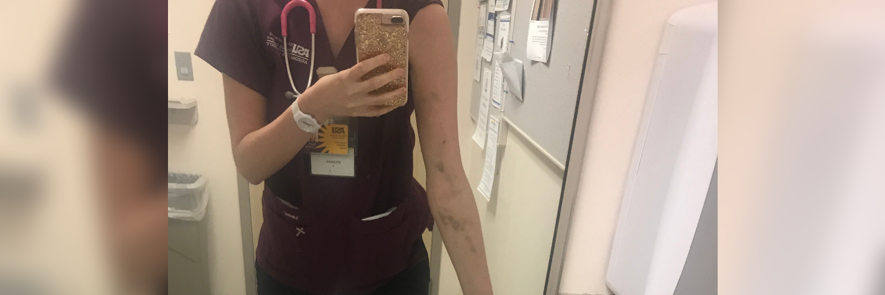 the author taking a selfie in a bathroom mirror wearing her nursing scrubs and showing bruises up and down her arms from IVs