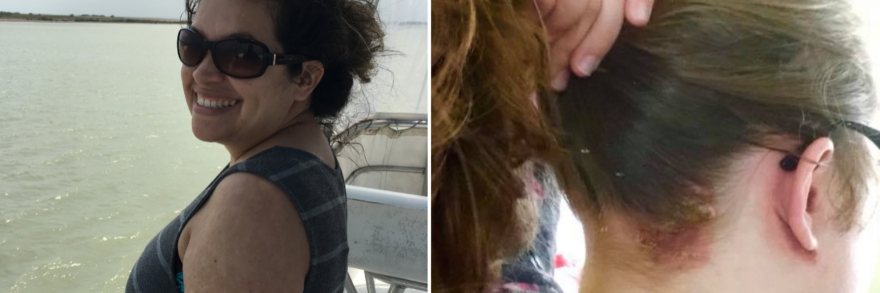 Photos of Skin Conditions That Aren't Contagious left photo: woman with a skin condition standing on a boat wearing sunglasses and smiling. right photo: woman holding her hair up in a ponytail to show a patch of psoriasis on her scalp