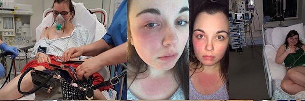The Dangerous Ways People Have Reacted to My Anaphylaxis collage of photos of girl with allergies