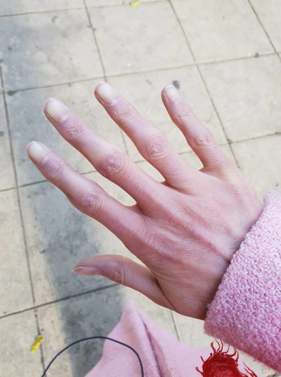 woman's hand with signs of raynauds and scleroderma