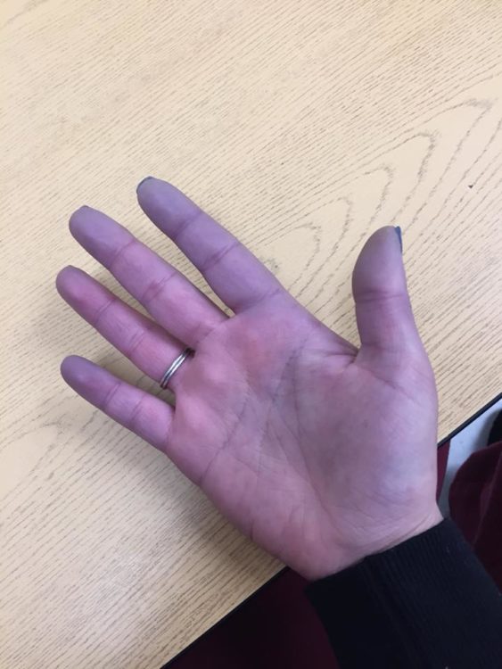 woman's hand that has turned completely purple