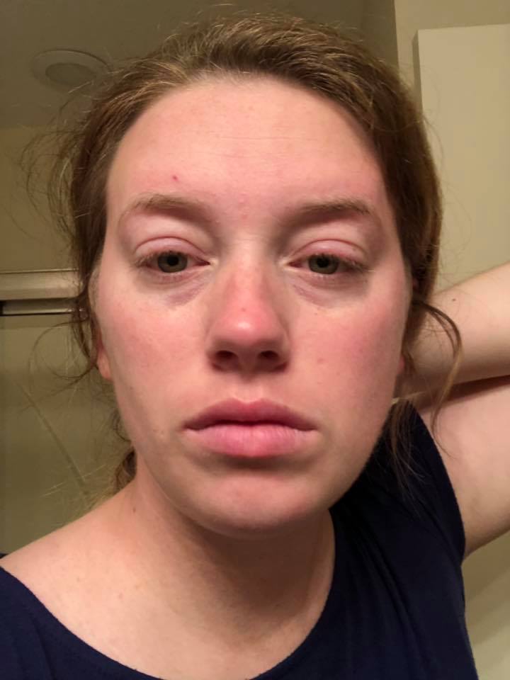 woman taking a selfie showing swollen eyelids