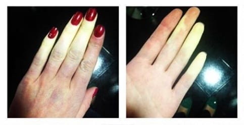 woman's hand with white fingers due to raynauds