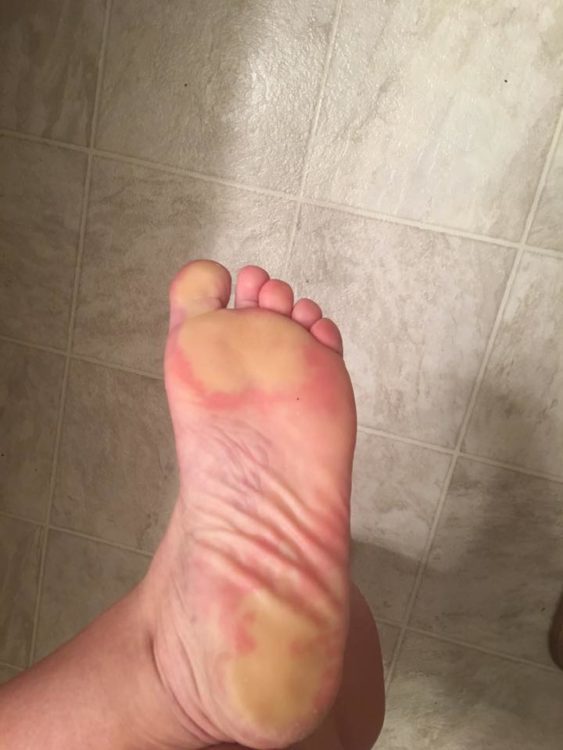 woman's foot with white patches due to raynauds