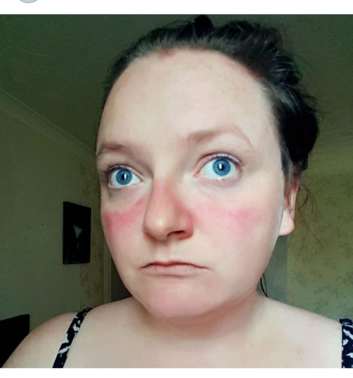 woman with red rash on face