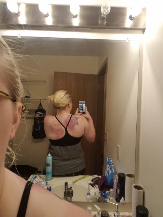 selfie of woman's back in the mirror showing cupping marks