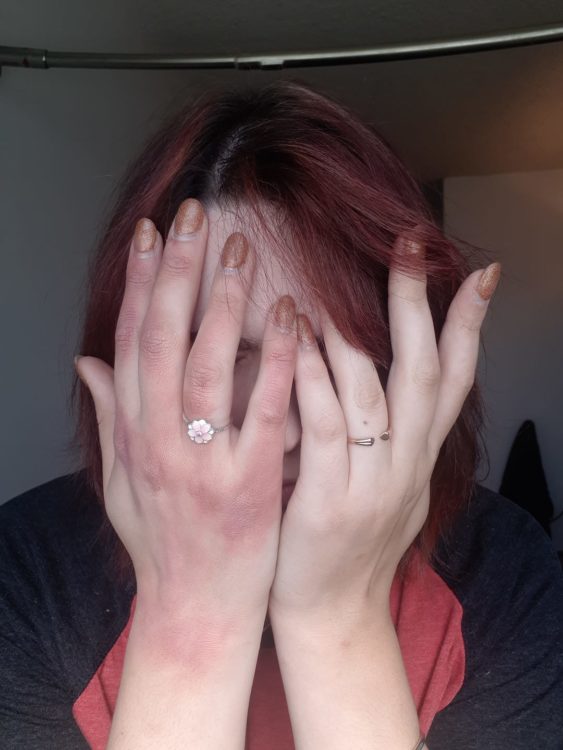 womans hands, one is swollen