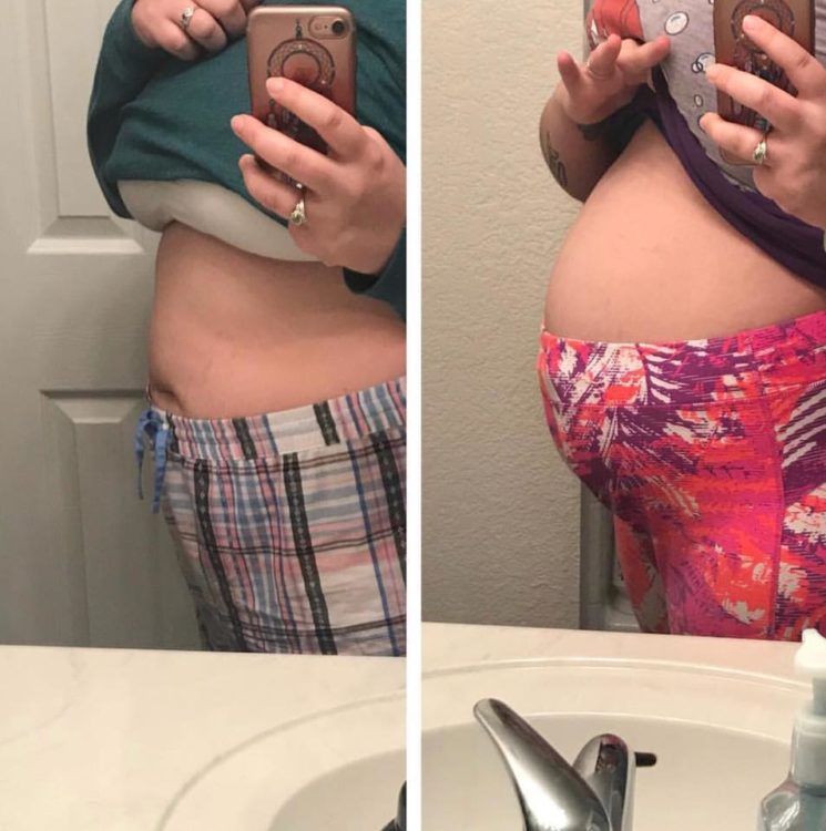 two mirror selfies of a woman's stomach, left side looking normal and right side swollen