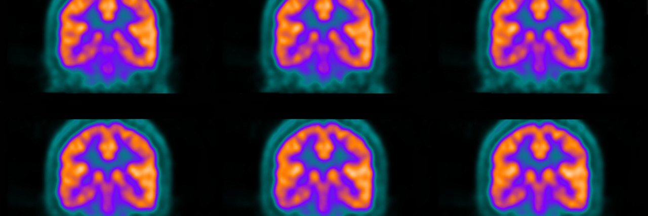 New Study Shows Brain Inflammation in Fibromyalgia Patients for the ...