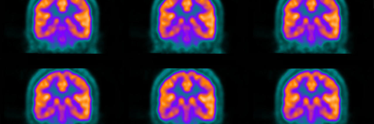 Study Images Glial Activation in the Brains of Fibromyalgia Patients PET scans of a brain