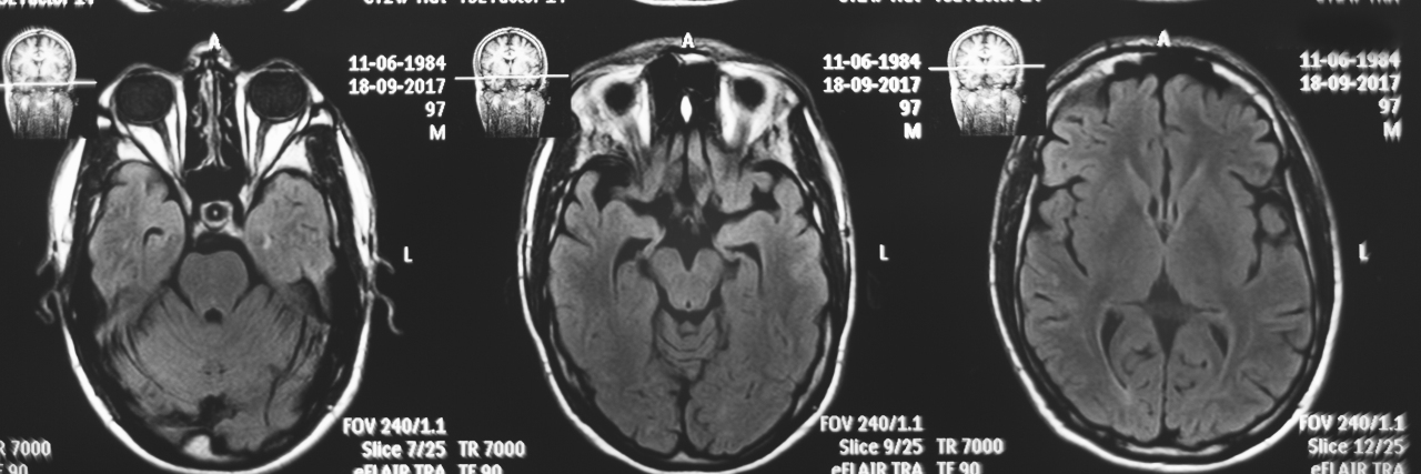 What I Lost and Gained After My Traumatic Brain Injury Magnetic resonance image of a brain.