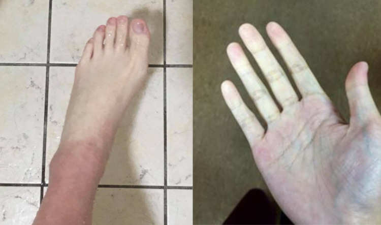 man's hand and foot that are totally white