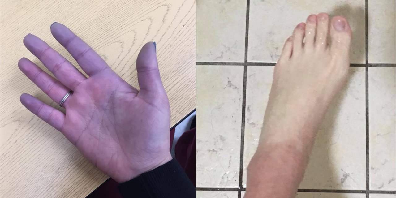 15 Photos That Show What Raynauds Phenomenon Looks Like The Mighty 