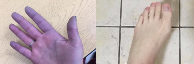 left photo: woman's hand turned purple. right photo: man's foot turned white