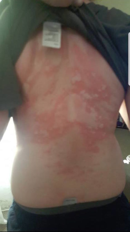 red rash across a woman's back