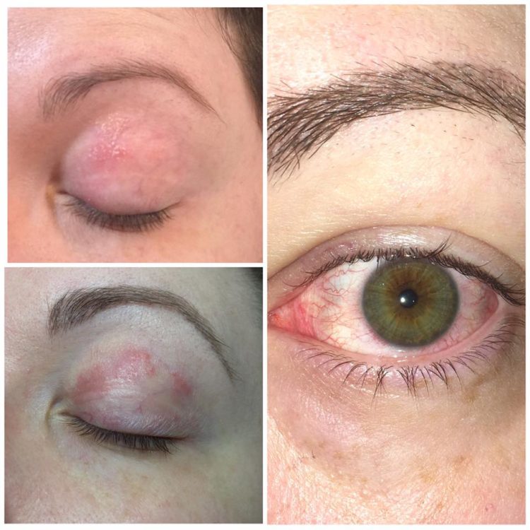 red rash on a woman's eyelid
