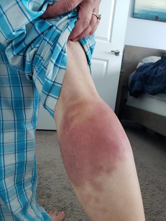 large bruise under a woman's knee