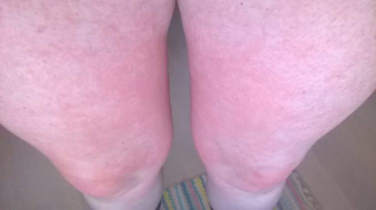 red rash on woman's thighs