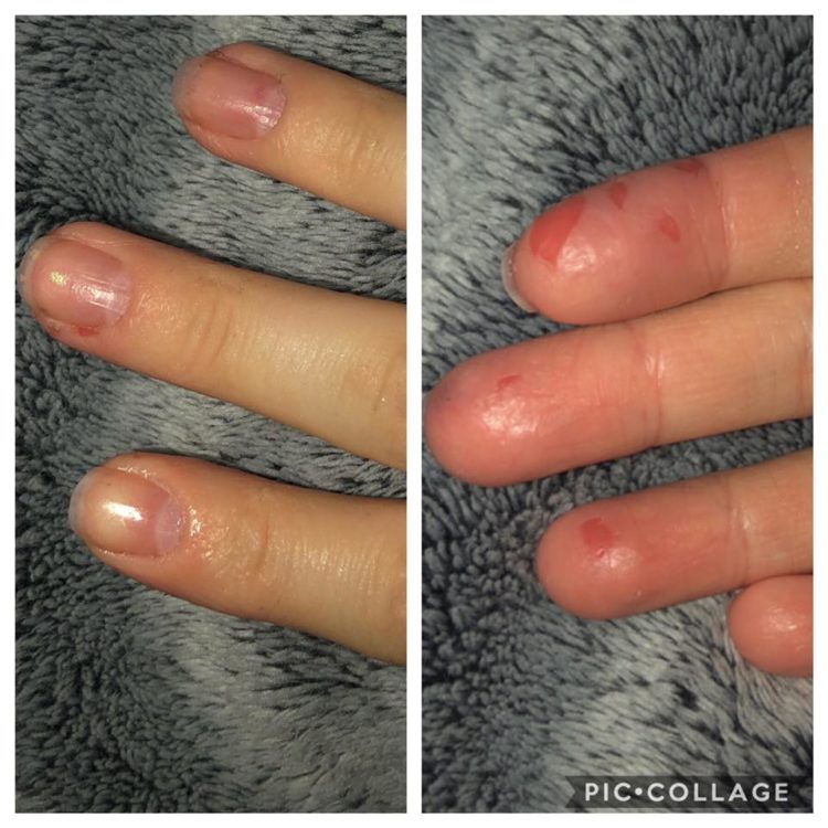 woman with torn bleeding skin around her fingernails