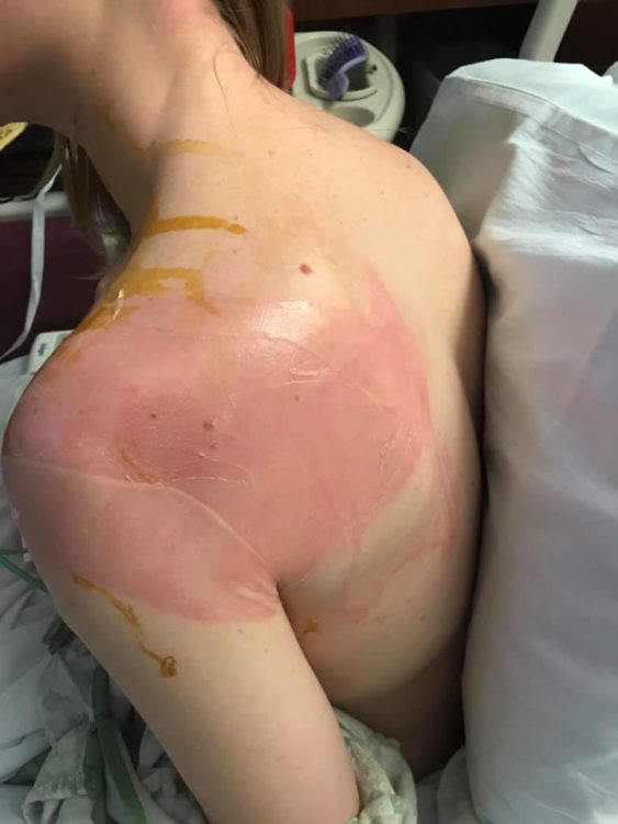 large red rash on a woman's shoulder