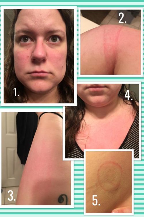 collage of photos of woman experiencing red rashes