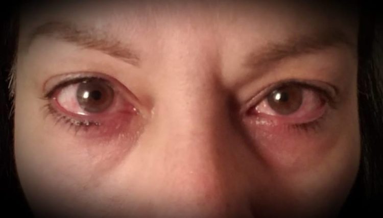 close up of woman's eyes that are red, swollen and watery