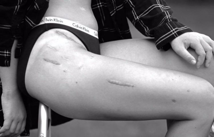 black and white photo of wide scars on a woman's thigh