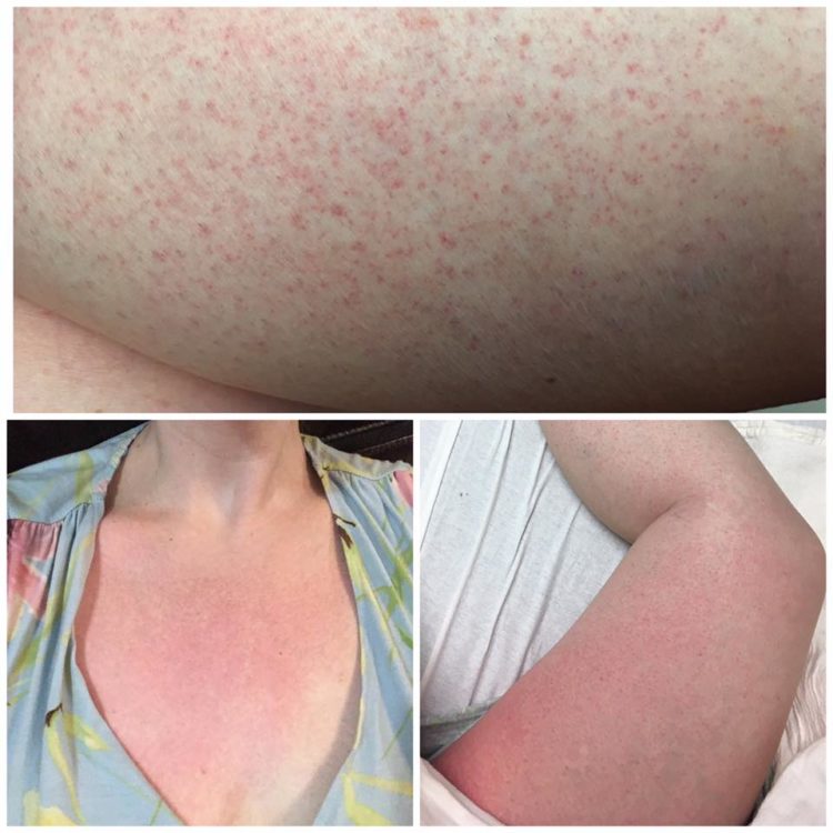 rash of small red dots across a woman's arms and chest