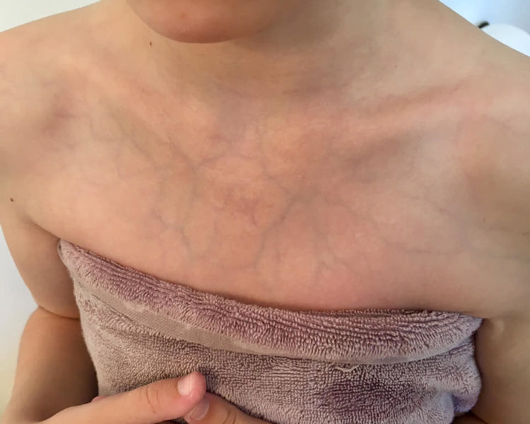 thin skin revealing lots of veins on a woman's chest