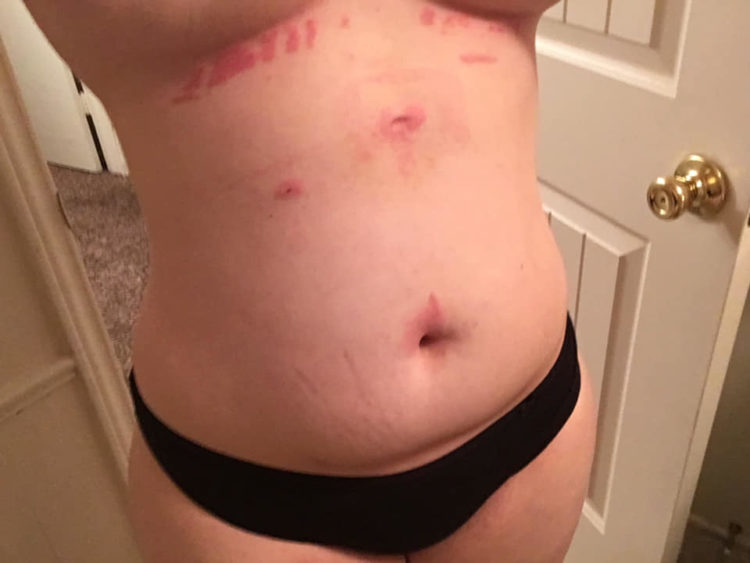red rashes and scars across a woman's abdomen