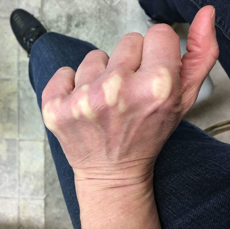 woman's hand curled into a fist showing very white knuckles