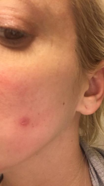 skin tear on a woman's cheek