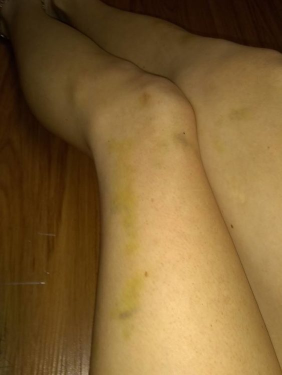 greenish-yellow bruises on a woman's legs
