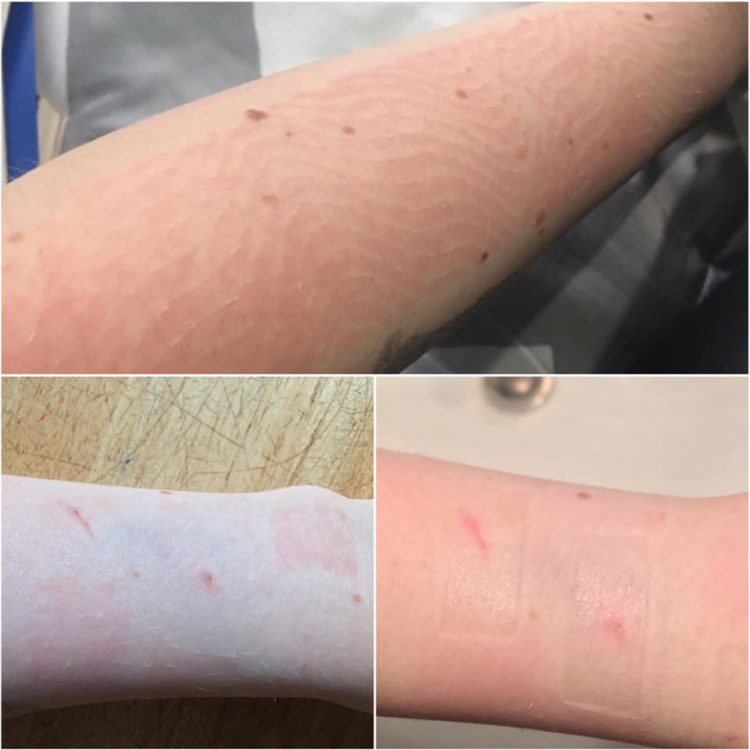 redness, tears and indentations from where a woman had adhesives on her skin