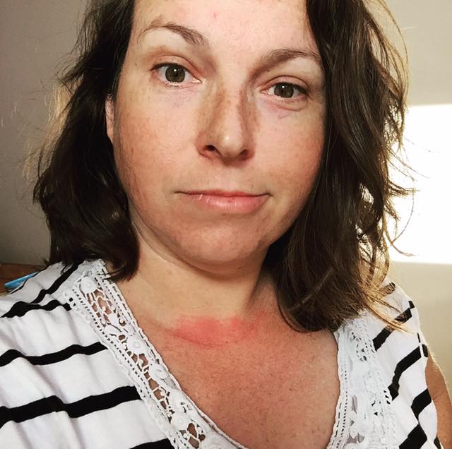 woman with a red rash across her chest