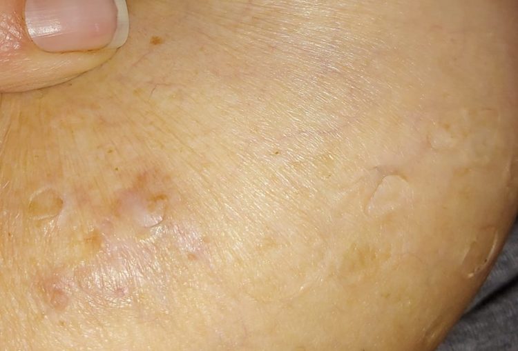atrophic scarring on a woman's skin