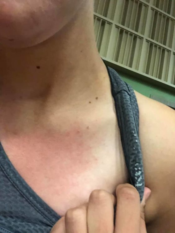 red rash on a woman's chest