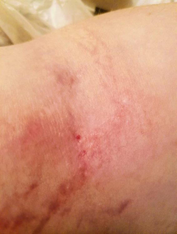 redness and scaring by a woman's IV site