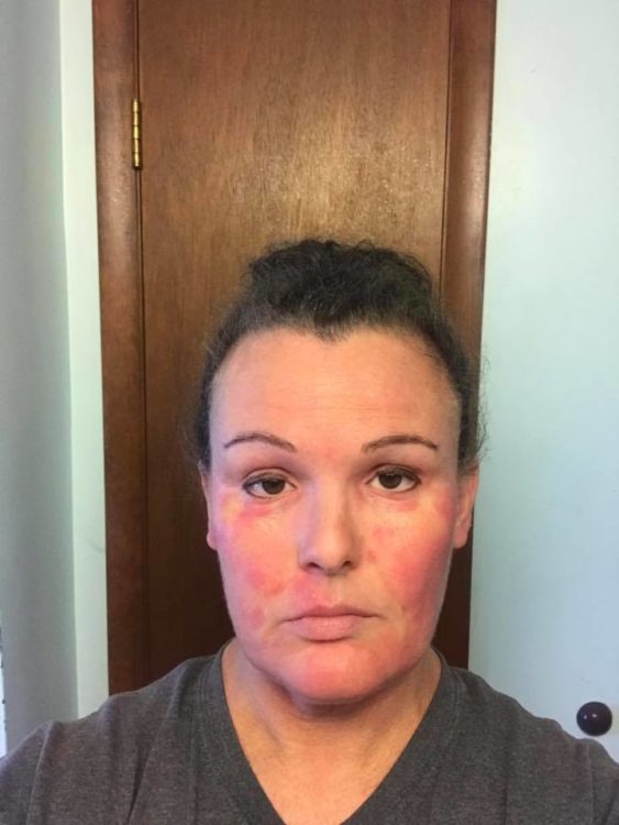 woman with red blotches across her cheeks