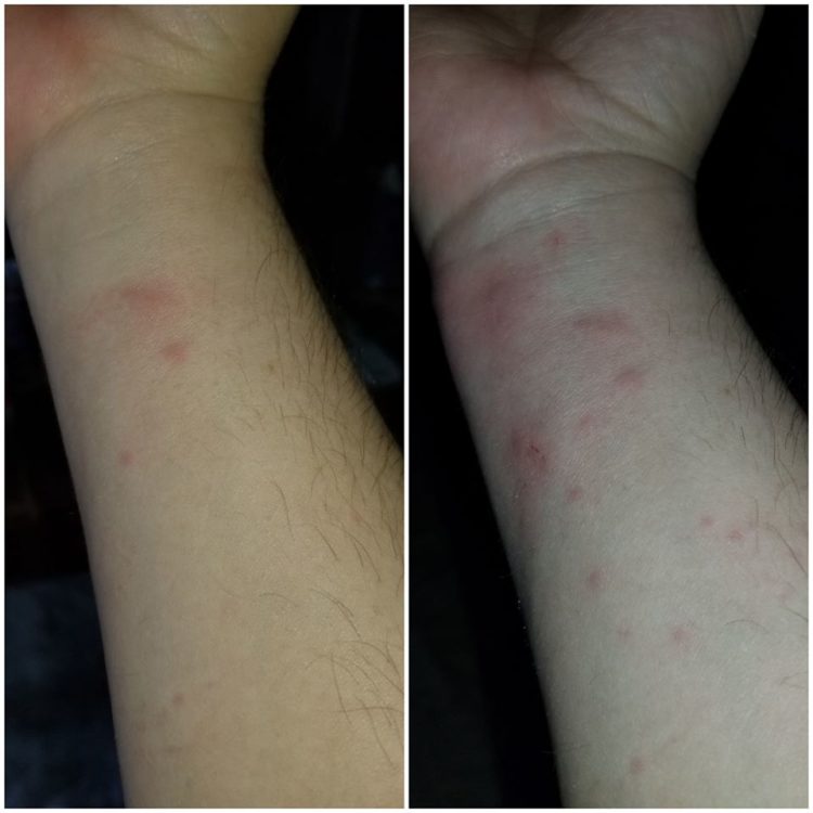 red hives on a woman's arm